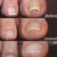 Homezore™ Nail Correction Patches